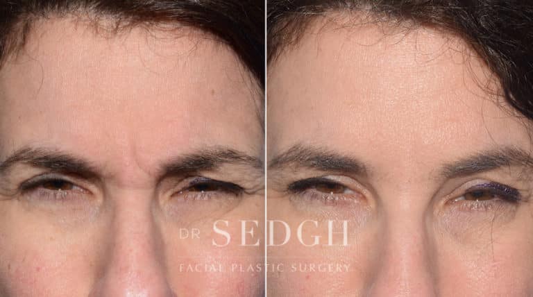 Wrinkle Relaxers Before and After | Sedgh