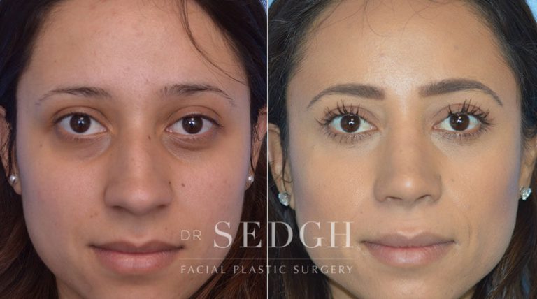 Rhinoplasty Before and After | Sedgh