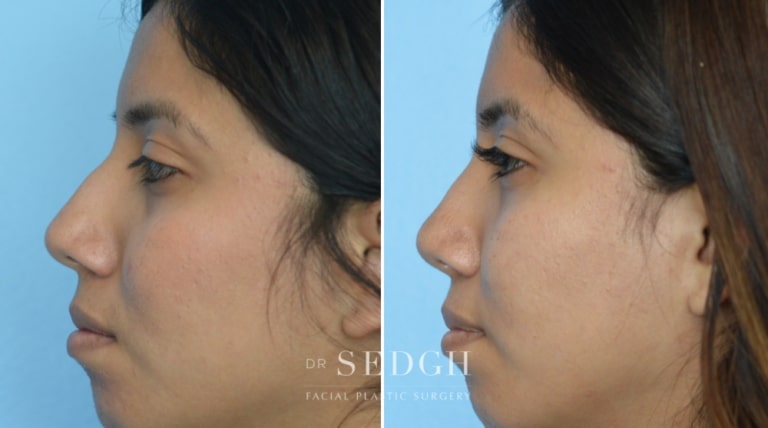 Rhinoplasty Before and After | Sedgh