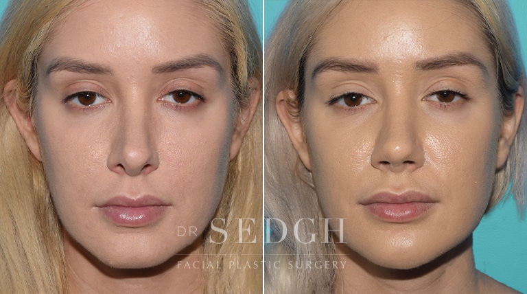 Revision Rhinoplasty Before and After | Sedgh