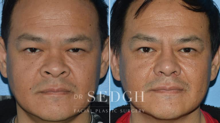 Rhinoplasty Before and After | Sedgh