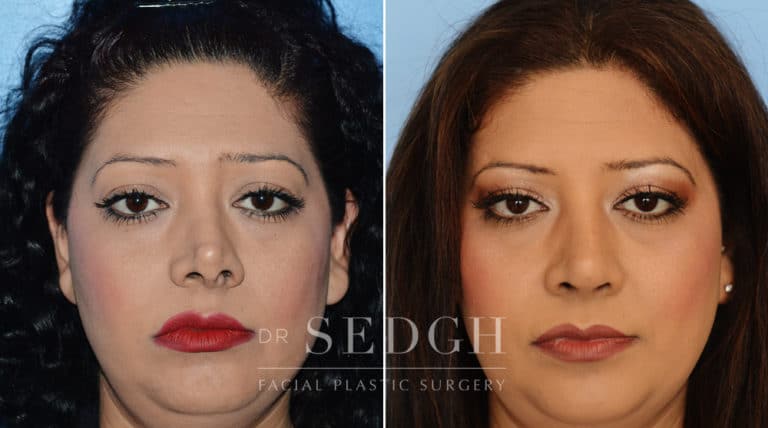 Nasal Fracture Before and After | Sedgh