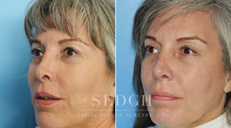 Revision Rhinoplasty Before and After | Sedgh