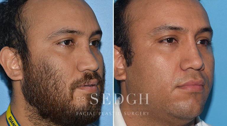 Rhinoplasty Before and After | Sedgh