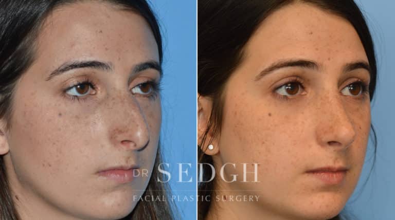 Rhinoplasty Before and After | Sedgh