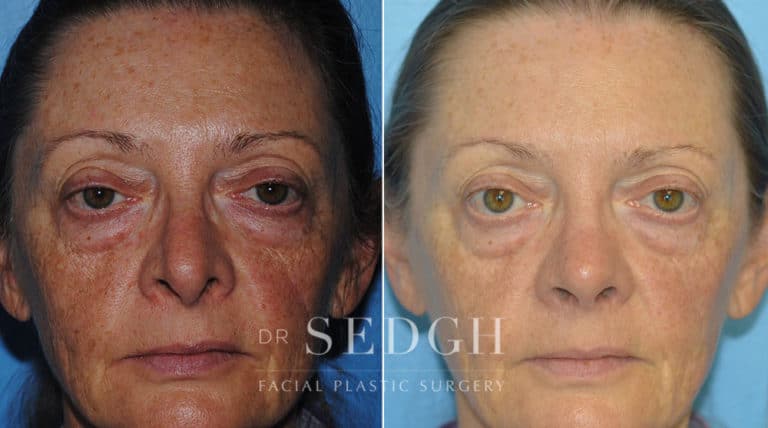 Revision Rhinoplasty Before and After | Sedgh