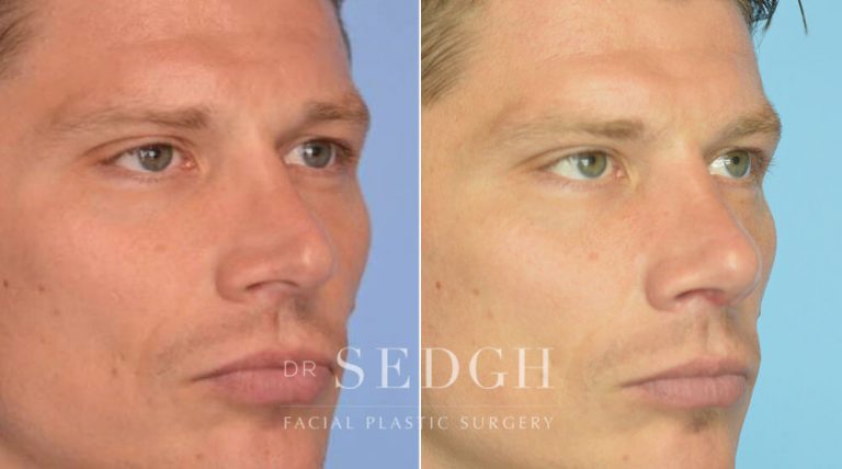 Rhinoplasty Before and After | Sedgh