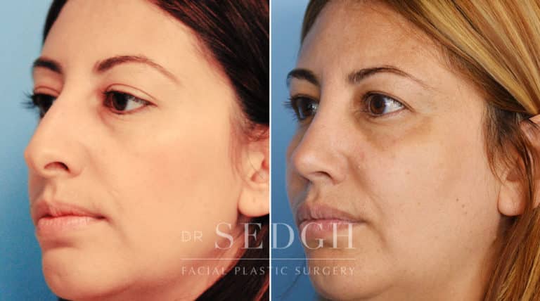 Rhinoplasty Before and After | Sedgh