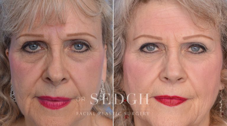 Revision Rhinoplasty Before and After | Sedgh