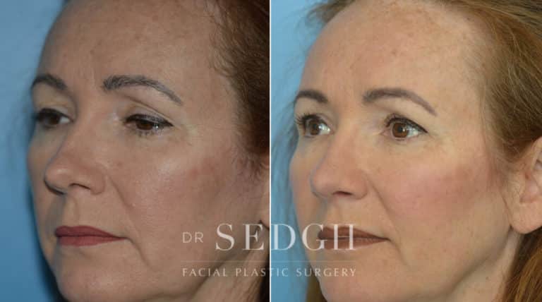 Rhinoplasty Before and After | Sedgh