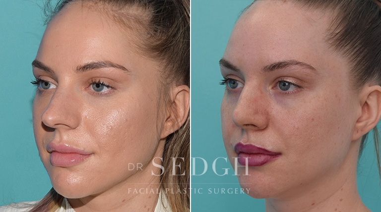 Crooked Nose Surgery Before and After | Sedgh