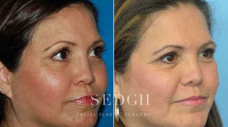 Crooked Nose Surgery Before and After | Sedgh