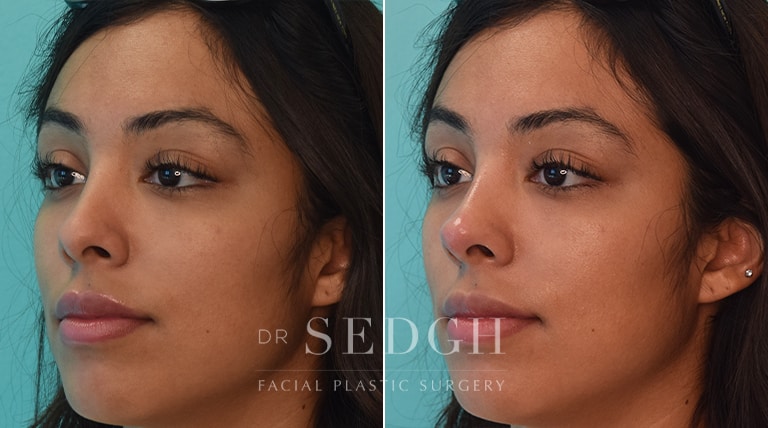 Facial Fillers Before and After | Sedgh