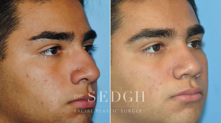 Crooked Nose Surgery Before and After | Sedgh