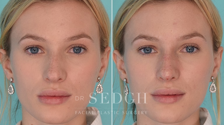 Facial Fillers Before and After | Sedgh