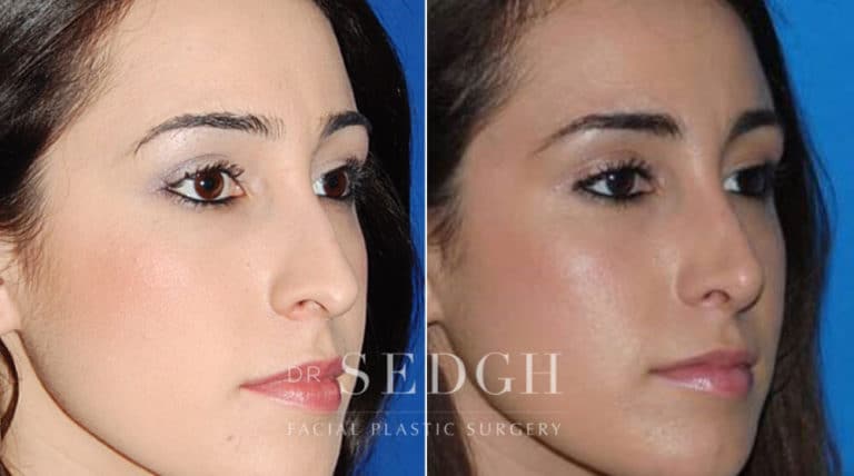 Crooked Nose Surgery Before and After | Sedgh