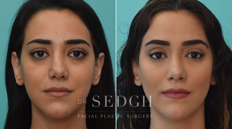 Facial Fillers Before and After | Sedgh