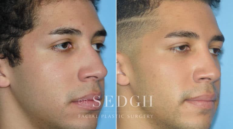 Crooked Nose Surgery Before and After | Sedgh