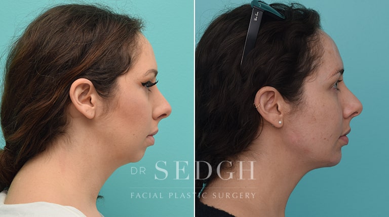 Facial Fillers Before and After | Sedgh