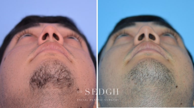Nasal Fracture Before and After | Sedgh