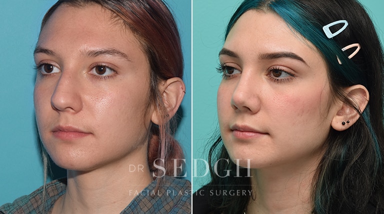 Rhinoplasty Before and After | Sedgh