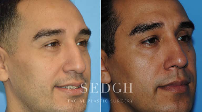 Rhinoplasty Before and After | Sedgh