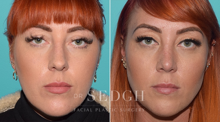 Facial Fillers Before and After | Sedgh