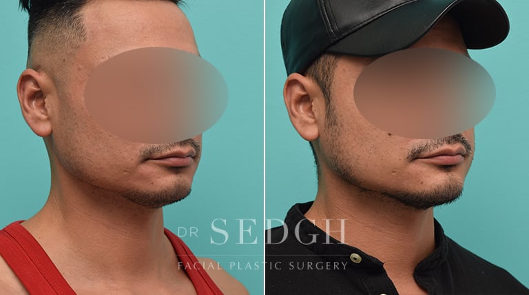 Facial Fillers Before and After | Sedgh