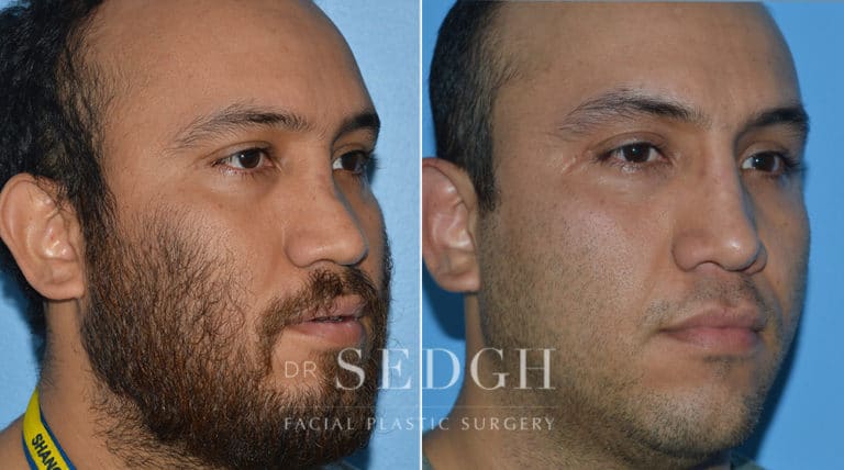 Crooked Nose Surgery Before and After | Sedgh