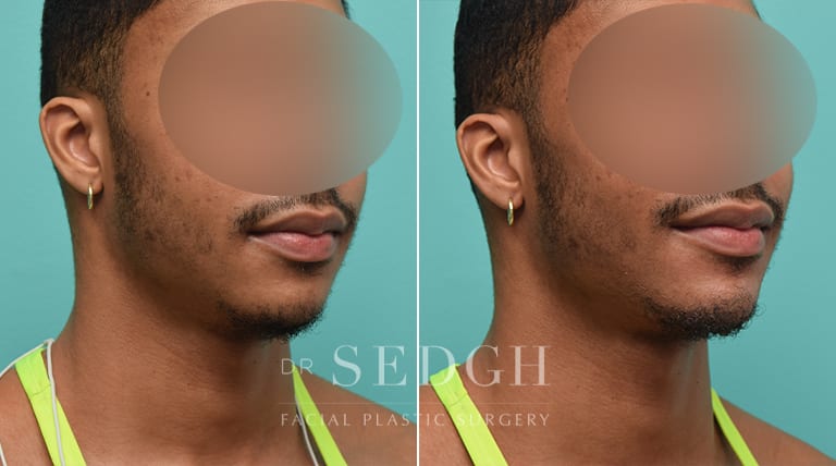 Facial Fillers Before and After | Sedgh