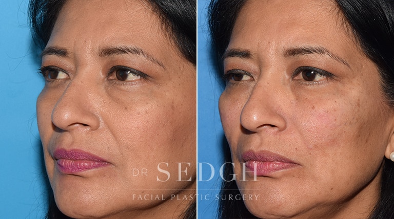 Facial Fillers Before and After | Sedgh