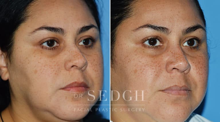 Crooked Nose Surgery Before and After | Sedgh