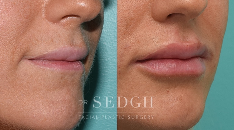 Lip Augmentation Before and After | Sedgh