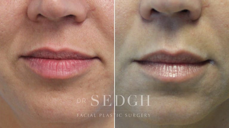 Lip Augmentation Before and After | Sedgh