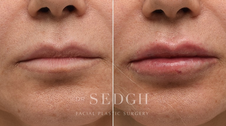 Lip Augmentation Before and After | Sedgh