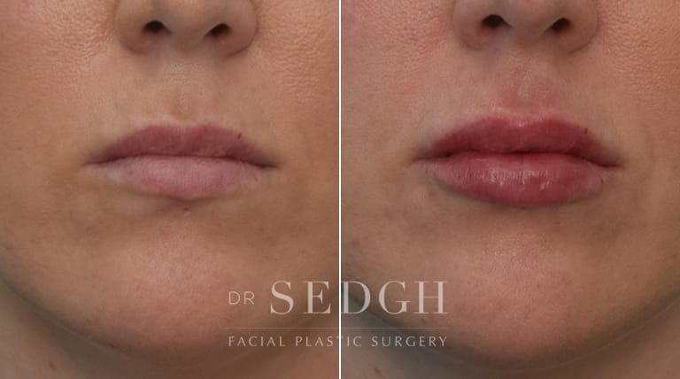 Lip Augmentation Before and After | Sedgh