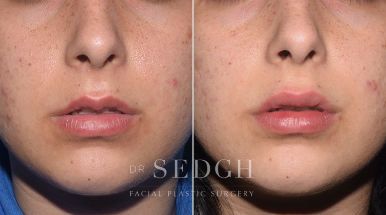 Lip Augmentation Before and After | Sedgh