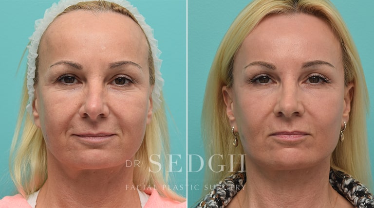 Laser Skin Treatments Before and After | Sedgh