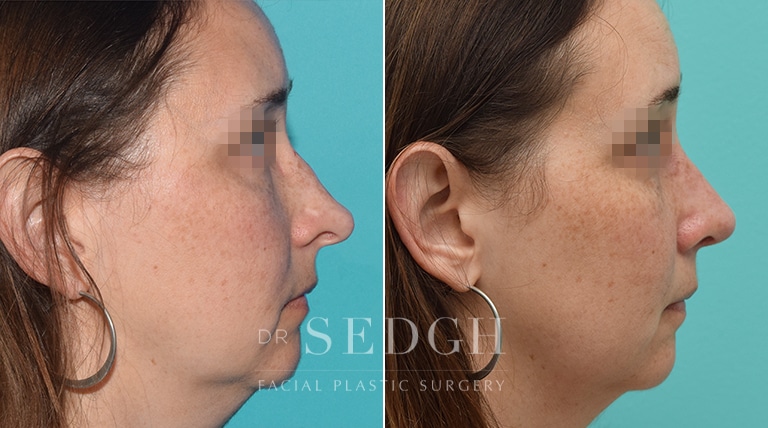 Female Rhinoplasty Before and After | Sedgh