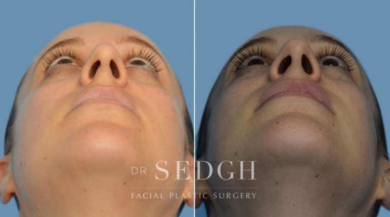 Rhinoplasty Before and After | Sedgh