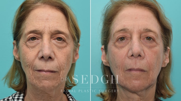 Laser Skin Treatments Before and After | Sedgh