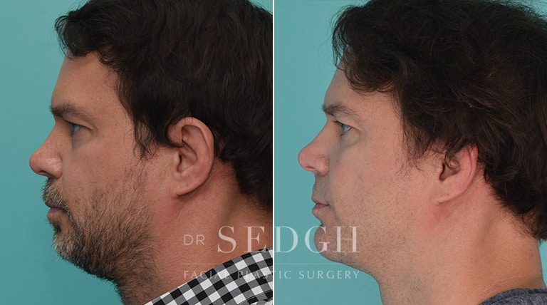 Chin Augmentation Before and After | Sedgh