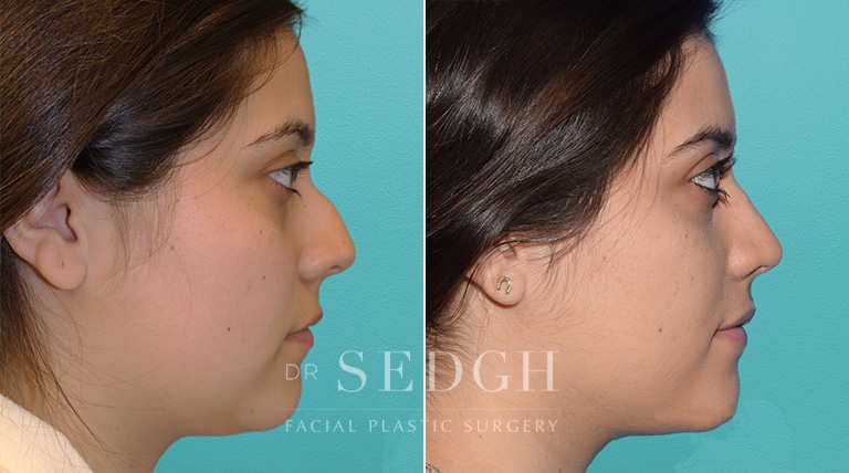 Female Rhinoplasty Before and After | Sedgh