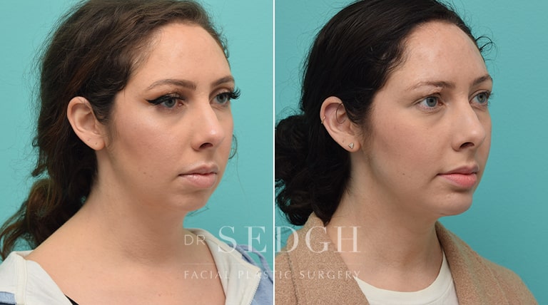 Chin Augmentation Before and After | Sedgh