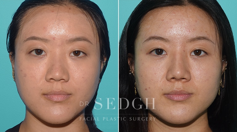 Female Rhinoplasty Before and After | Sedgh