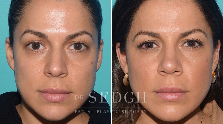 Female Rhinoplasty Before and After | Sedgh