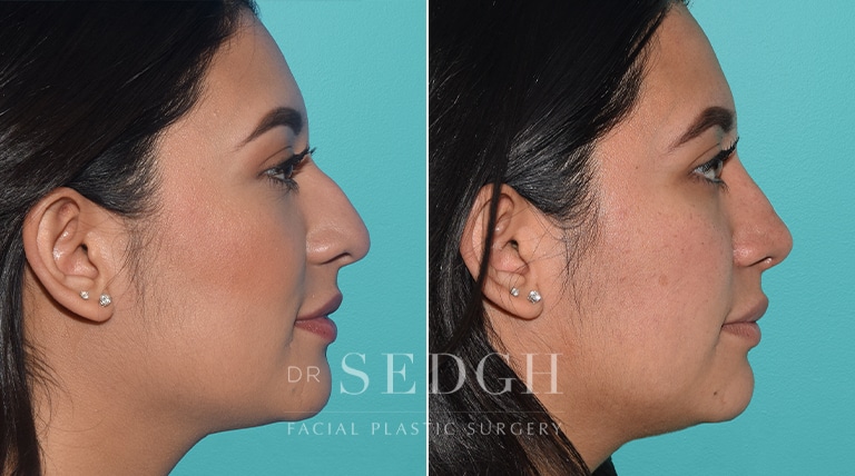 Female Rhinoplasty Before and After | Sedgh