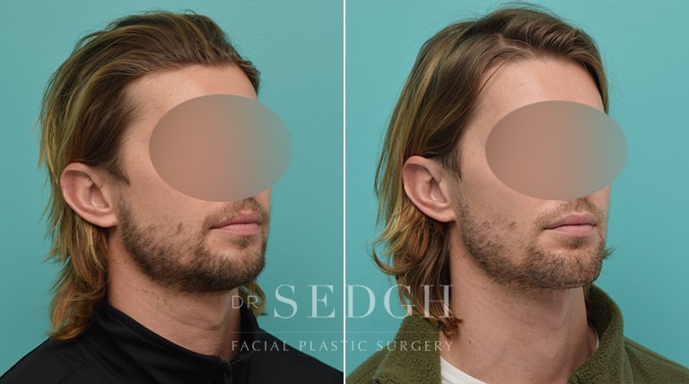 Chin Augmentation Before and After | Sedgh