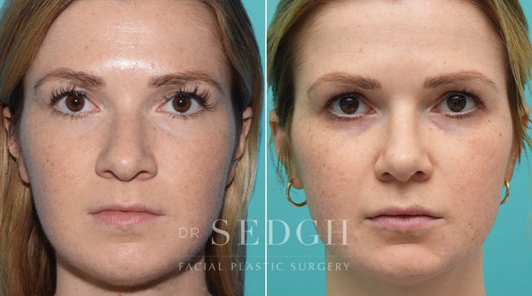 Female Rhinoplasty Before and After | Sedgh