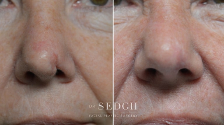 Scar Revision Before and After | Sedgh